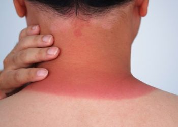 Sonnenbrand ist vermeidbar. Quelle: ERGO/Canva