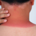 Sonnenbrand ist vermeidbar. Quelle: ERGO/Canva